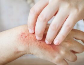 Las infecciones fúngicas (por hongos) tienen un alto porcentaje de incidencia en nuestro país. Se trata sin duda, un caso de interés para la salud pública.